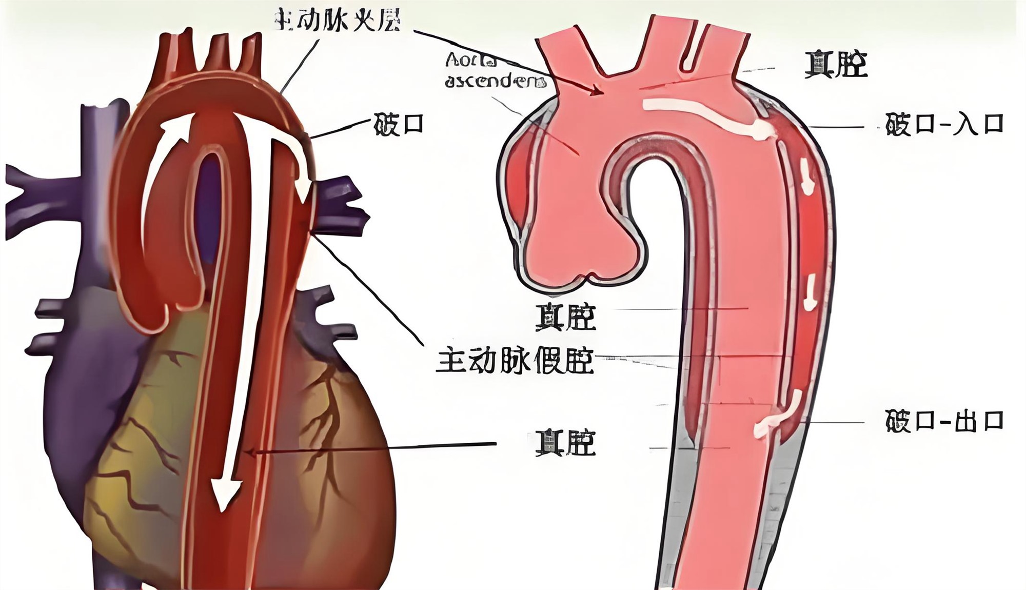 A型主动脉夹层合并偏瘫急诊诊疗方案