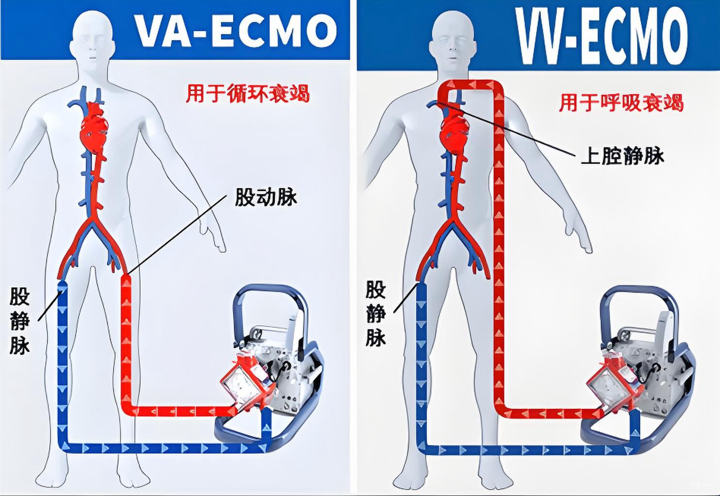VA-ECMO在CRTD术后心脏骤停中的应用指征与决策分析