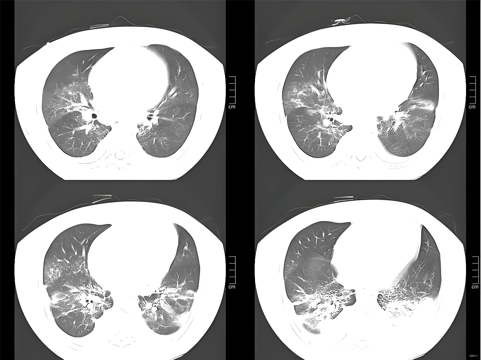 咯血贫血肾功能不全患者诊疗方案（2025指南更新）
