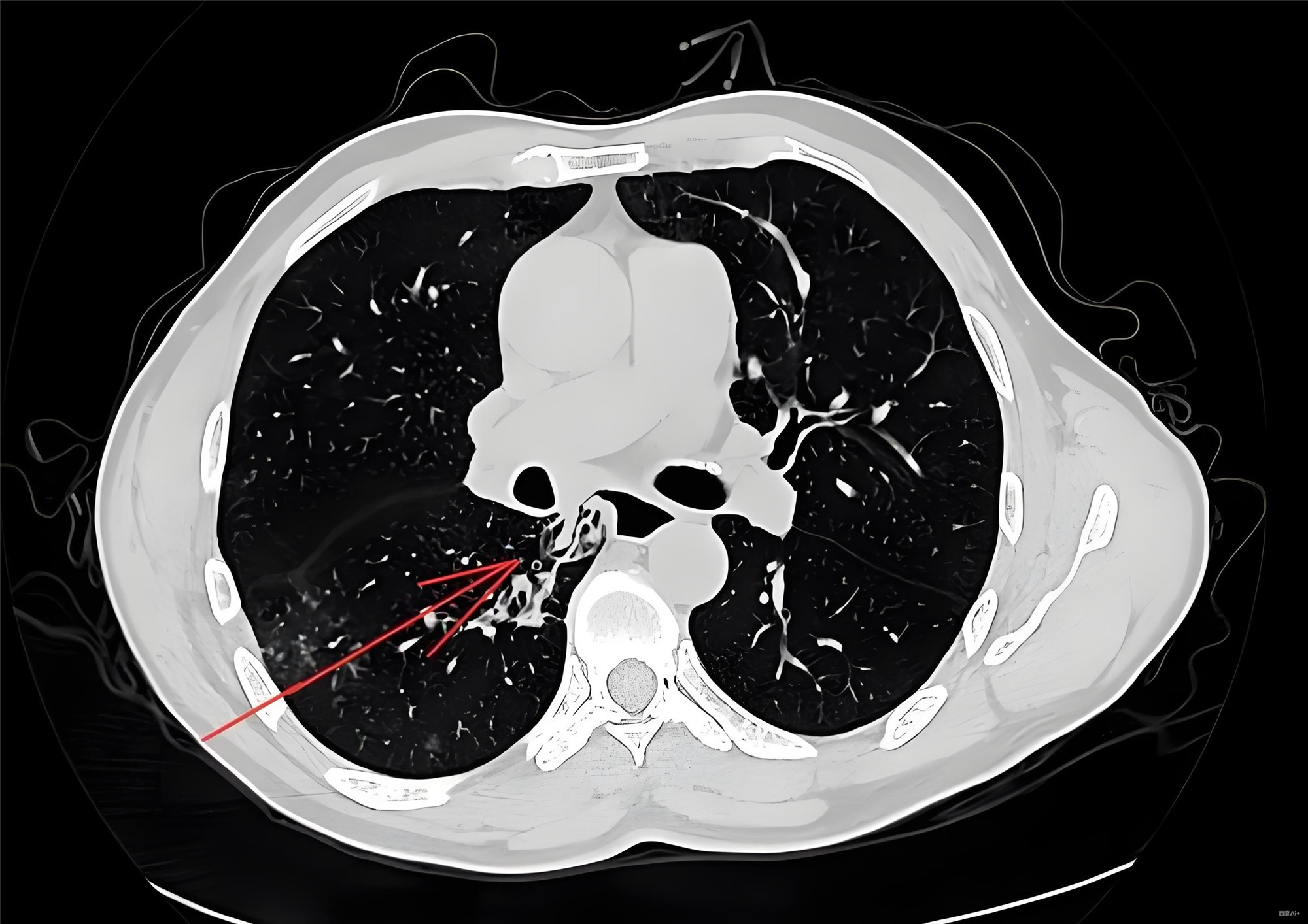 食管恶性肿瘤继发食管纵隔气管瘘系统综述及病例报告
