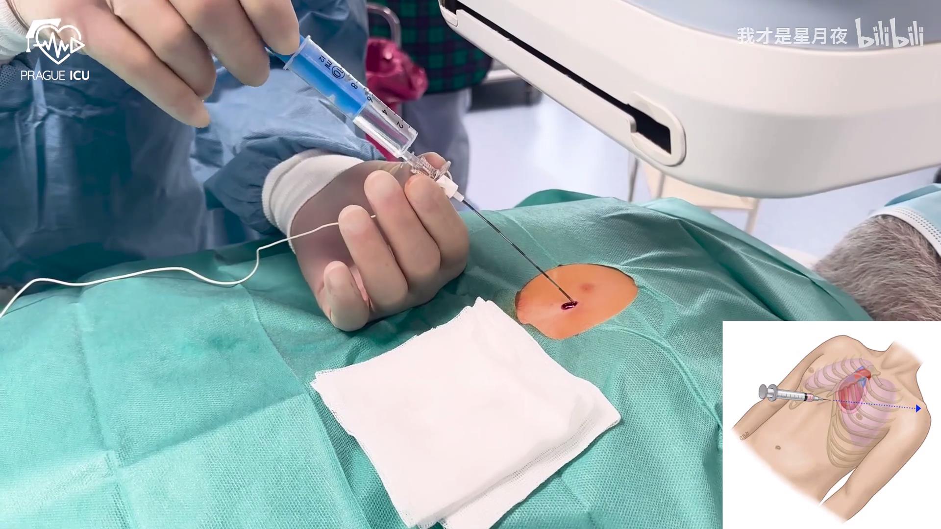 心包穿刺术Pericardiocentesis